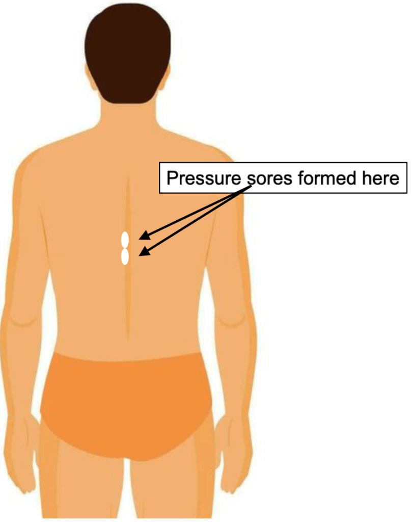 Pressure Sores, Bandages, and Treatments - image2