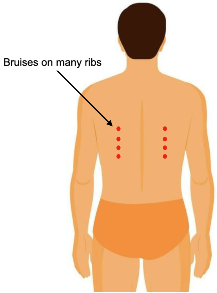 Pressure Sores, Bandages, and Treatments - image4