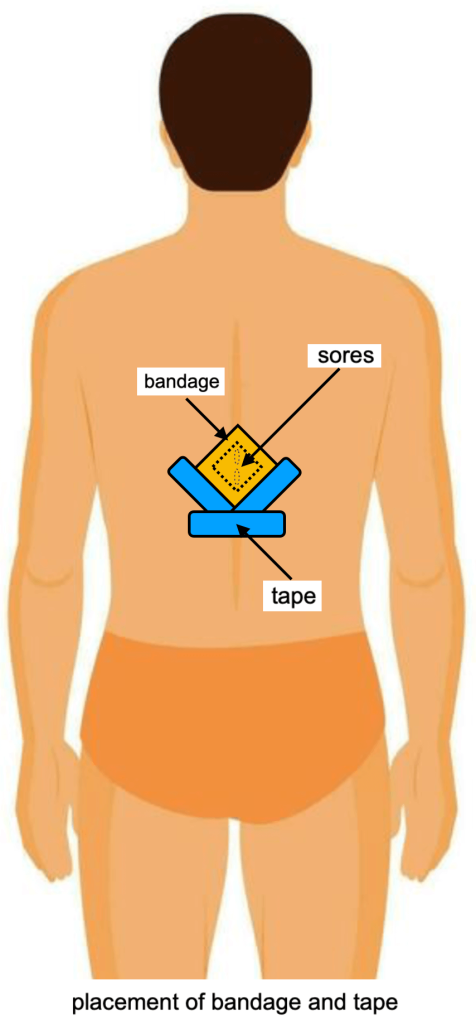 Pressure Sores, Bandages, and Treatments - image6
